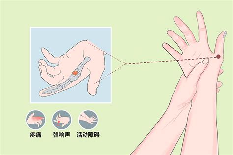 指根|手指腱鞘炎的自我诊断和自我治疗